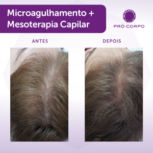 Mesoterapia Capilar na Pró-Corpo